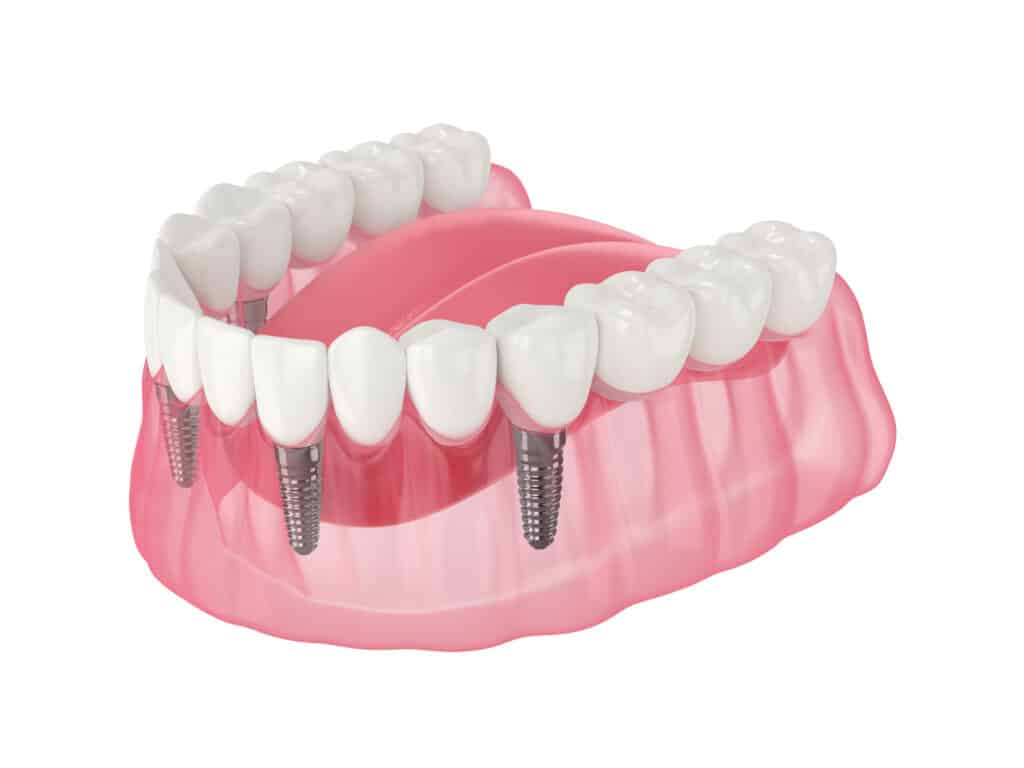 Full-Arch Implant Solutions — Hamilton Township, NJ — Kuser Family Dental