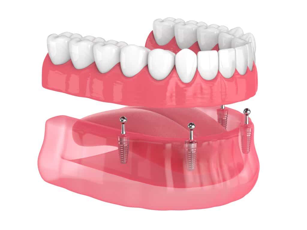 Kuser Full-Arch Implant Solutions — Hamilton Township, NJ — Kuser Family Dental